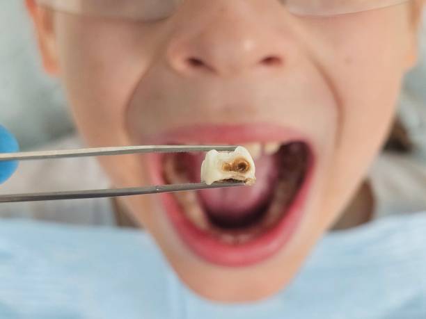 Best Dentist for Tooth Abscess  in Penn State Erie, PA